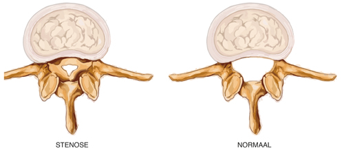 kanaalstenose fysiotherapie